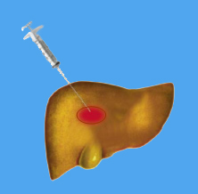 Ethanol Injection