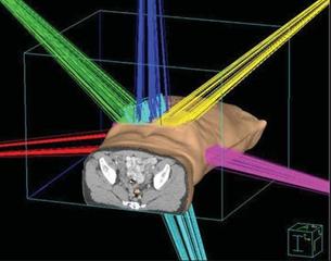 radiotherapy